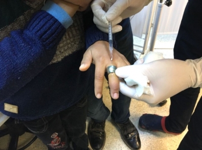 Çocuğun Parmağına Sıkışan Yüzük Hastanede Çıkartıldı