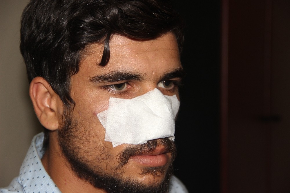 Kavga ettiği kuzeni tarafından burnu ısırılarak koparıldı