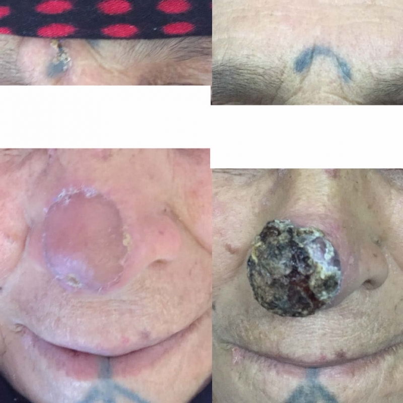 Balıklıgöl hastanesinden başarılı bir ameliyat.