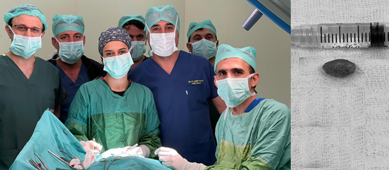 Boynundaki Şişlikten Taş Çıktı