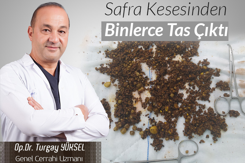 Safra Kesesinden Binlerce Taş Çıktı